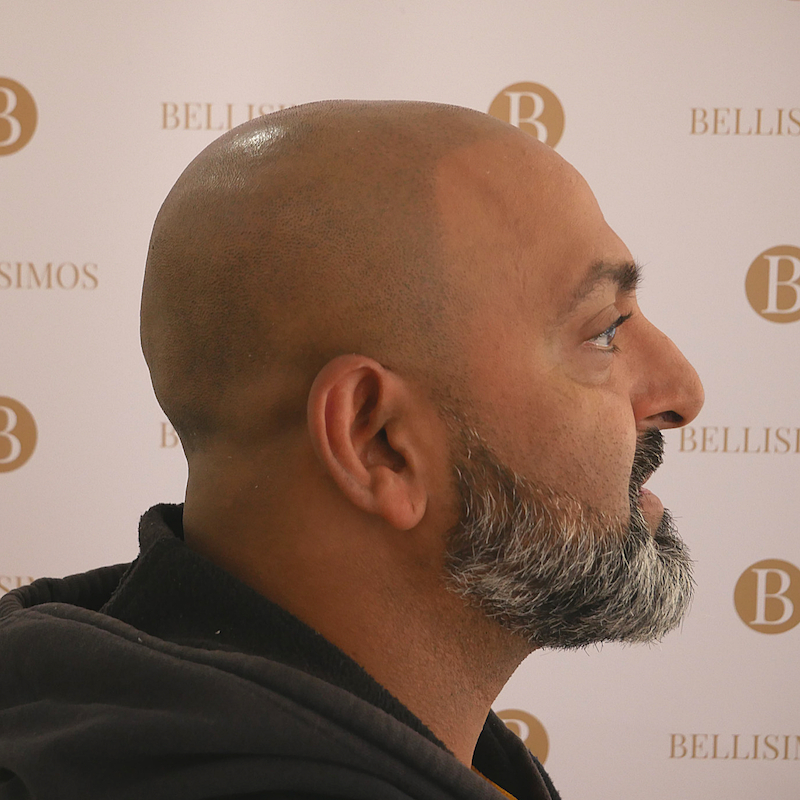 Scalp Micropigmentation